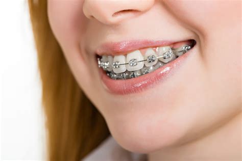 los brackets metalicos son buenos|que es un bracket metal.